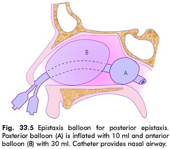 MEDICAL IMAGES: Epistaxis balloon MEDICAL IMAGES: Epistaxis balloon