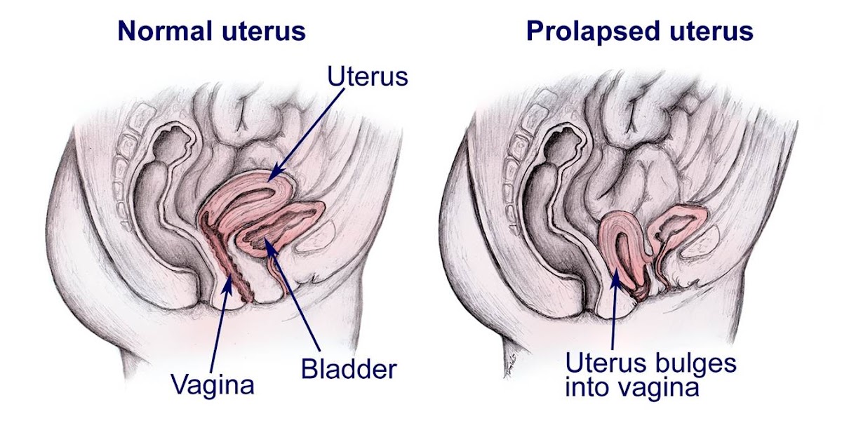 diagram of prolapsed uterus images prolapsed uterus diagram of prolapsed uterus images prolapsed uterus
