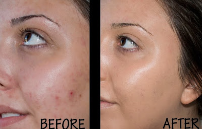 proactive before and after