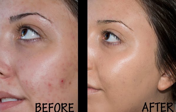 Valentine Kisses Before After Pics Over Valentine Kisses Before After Pics Over