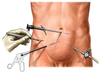 [nephrectomy]