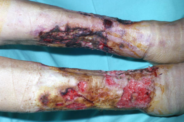 [calciphylaxis.jpg]