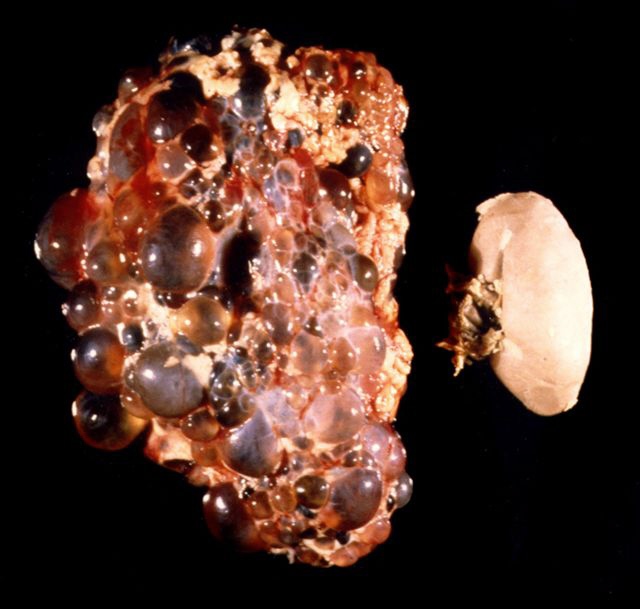 [PKD+Photo.jpg]