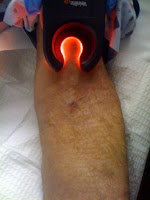 Vein-Light-Technology-IV-Access