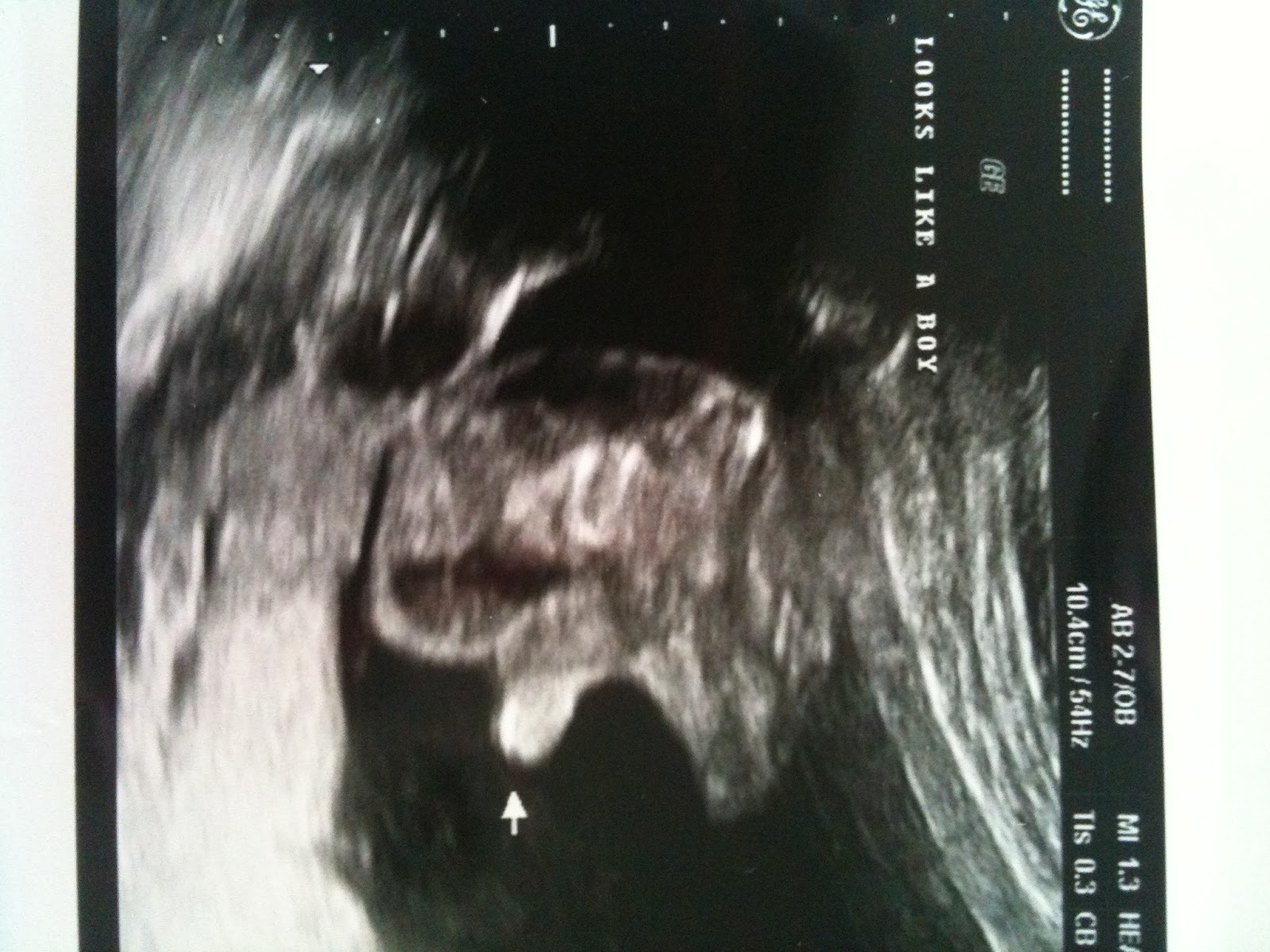 Ten Week Ultrasound