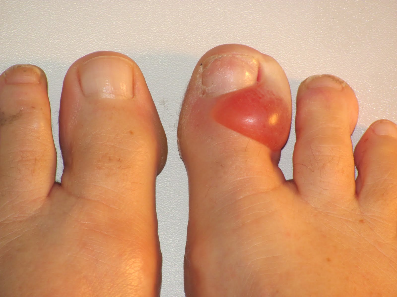 large blister