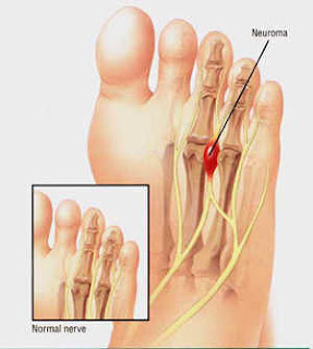Steroid injection in top of foot