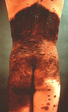 Hairy Nevus Birthmark