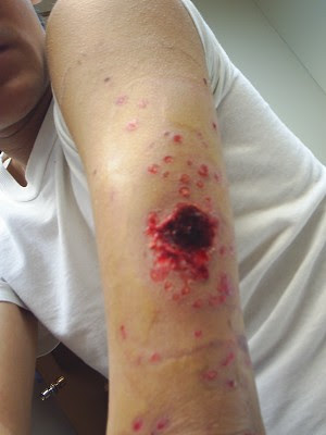 Rubber Bullet Injuries