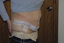 Tummy tuck post op side