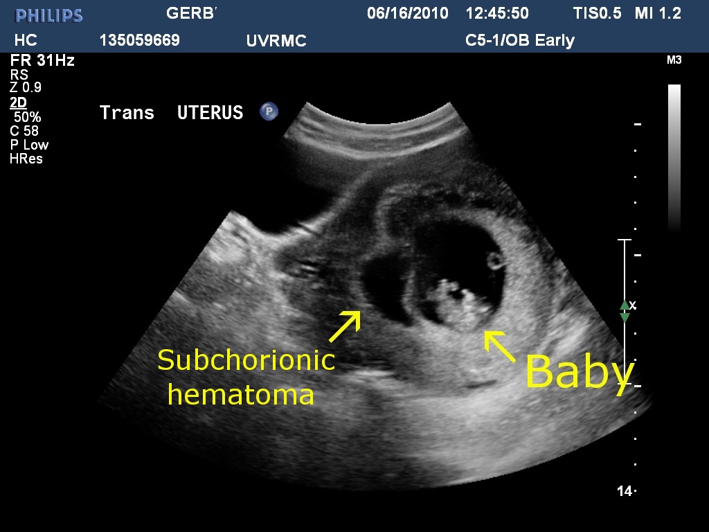 If you don't like to read about bleeding or pregnancy-related stuff, ... If you don't like to read about bleeding or pregnancy-related stuff, ...