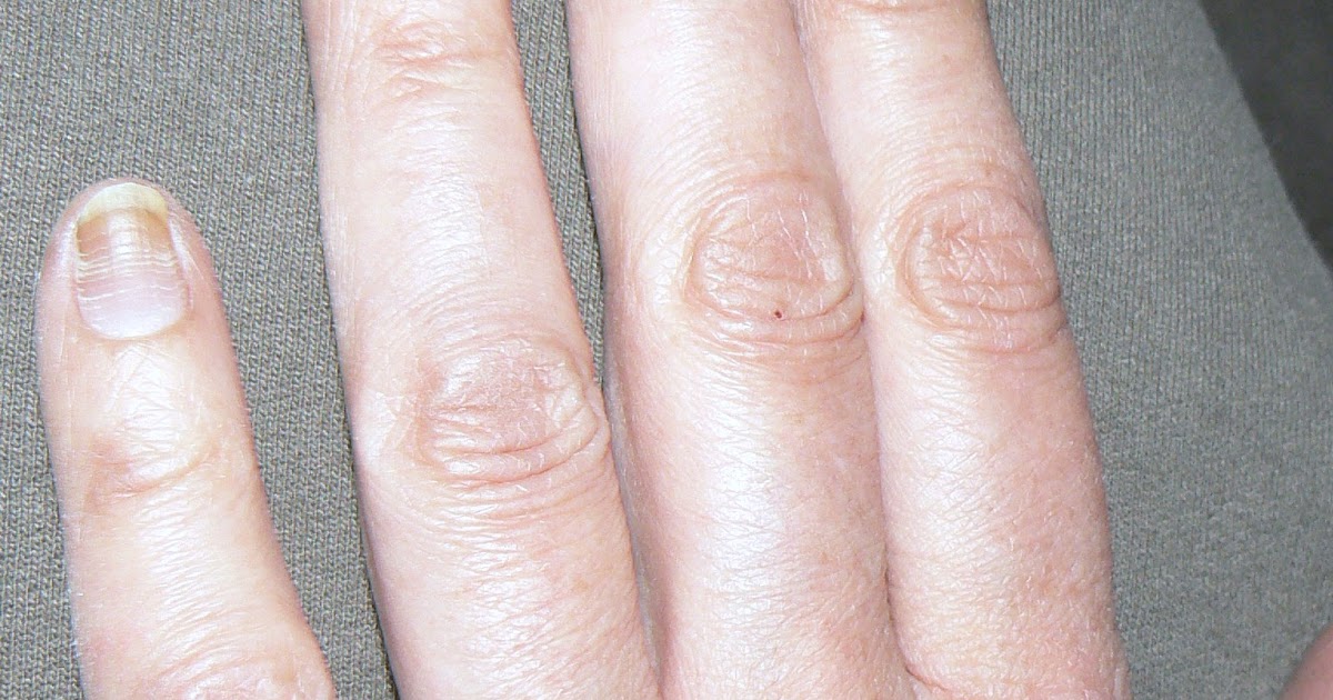 Living with Cancer Chemo Nails