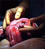 Fetal Surgery Videos