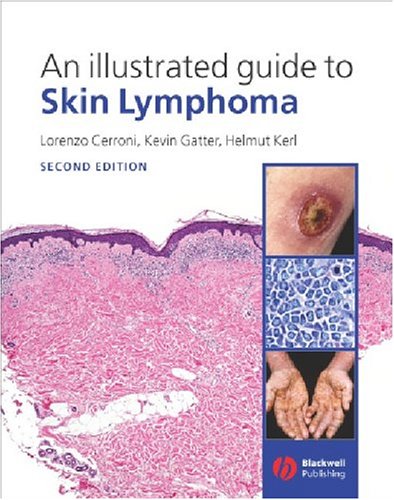 [skin+lymphoma.jpg]