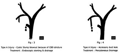 Bismuth+Classification+Of+Bile+Duct+Injuries ... preparation: 66 - Bismuth-Strasberg classification of Bile duct injury
