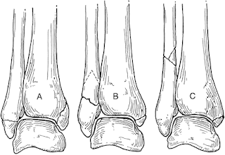 pott s fracture