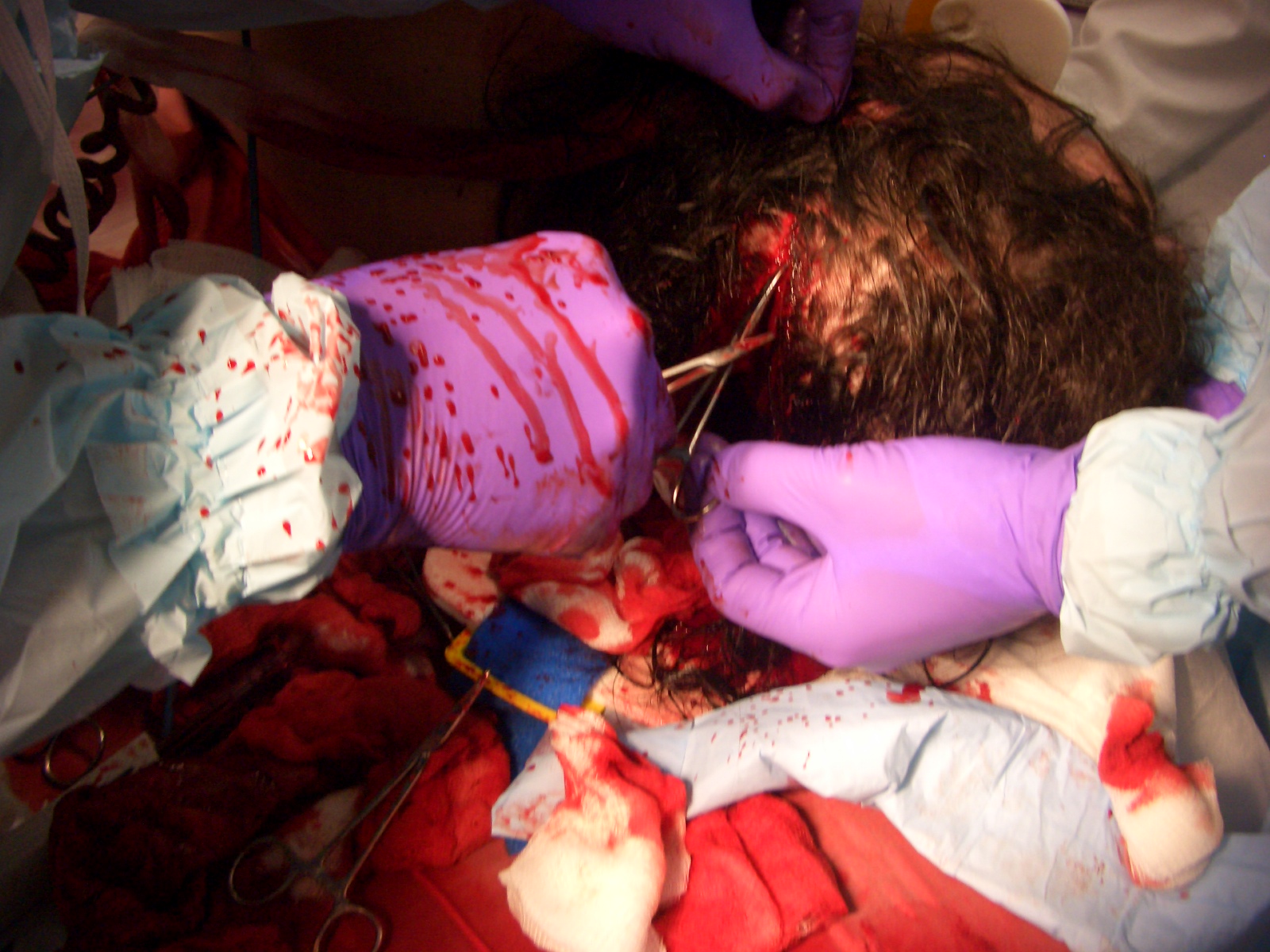 [bleeding+scalp.jpg]