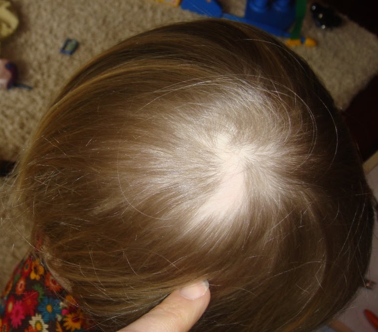 Preemie Beth Beth�s Bald Spot
