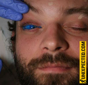 eyeball tattooed black. eyeball tattooing. eyeball tattooed black.