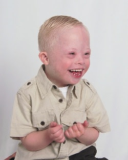 Jacob Syndrome
