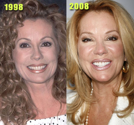 Recovery Plastic Surgery on Kathy Gifford Recovery