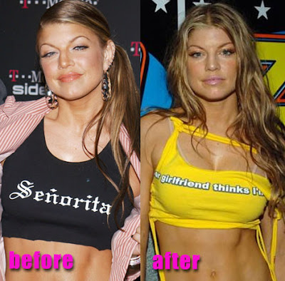 Fergie Plastic Surgery on Fergie Breast Implants  Before And After Boob Job Surgery