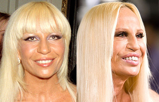 Plastic Surgery Gone Wrong