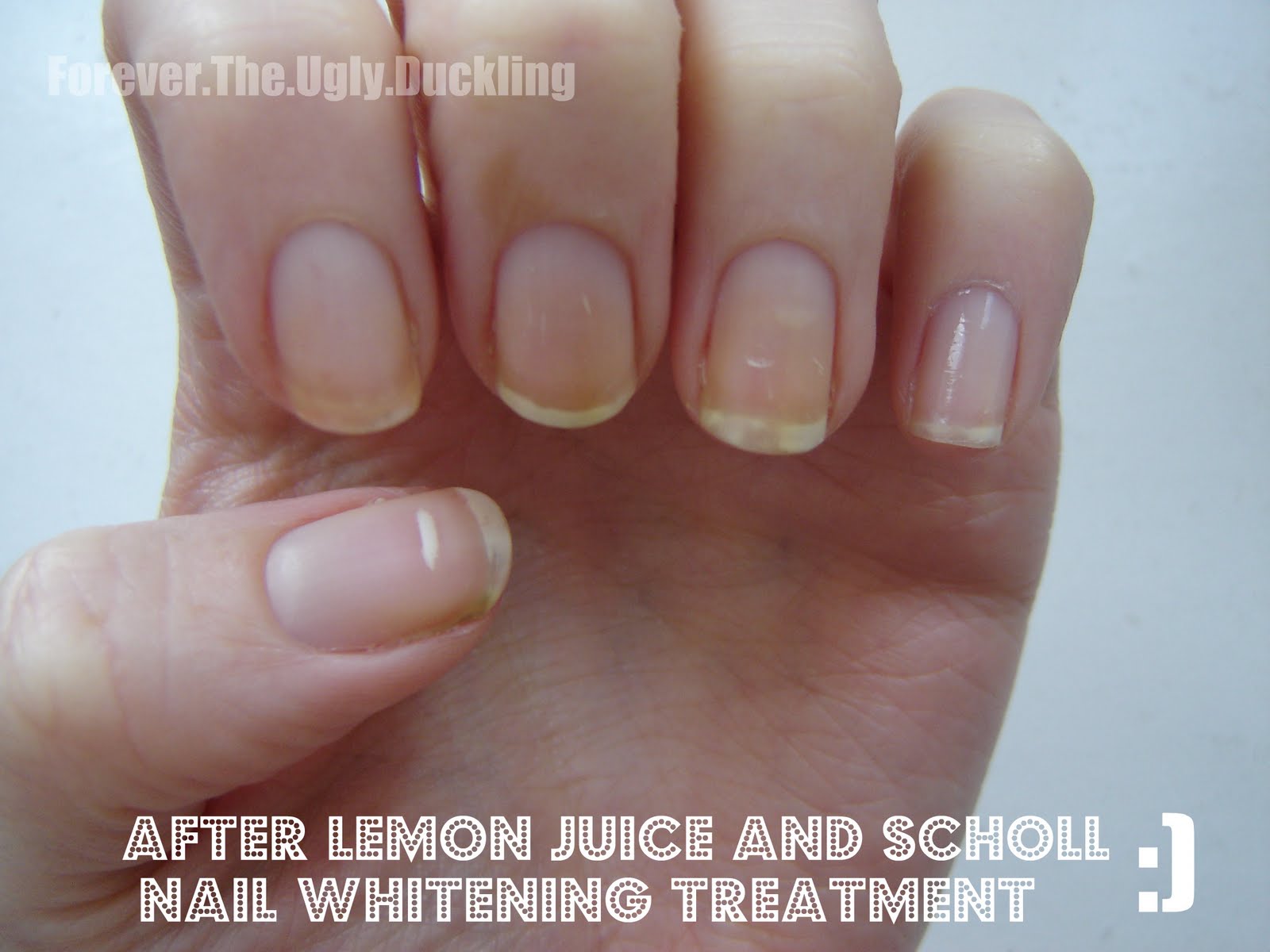 Here is my nails after 5 days of treatment with both the lemon juice and