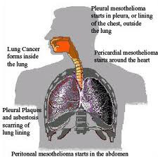 MESOTHELIOMA’S CAUSE