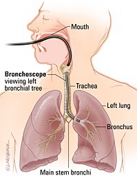[bronchoscopy.jpg]