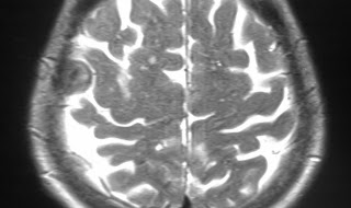 meningioma ct calcified