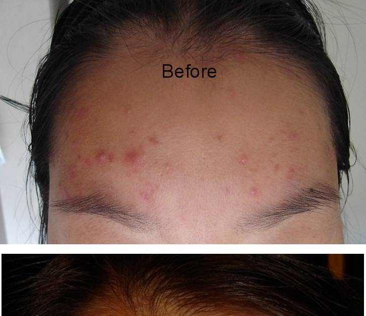 Scar Fade Gel acne scars, stretch marks, Scar Fade removes old and