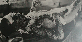 hiroshima atomic nuclear bomb body burned war crime