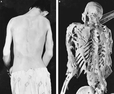 Fibrodysplasia Ossificans Progressiva<br />
