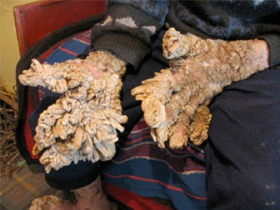 Lewandowsky-Lutz Dysplasia