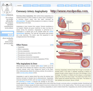 Angioplasty Example