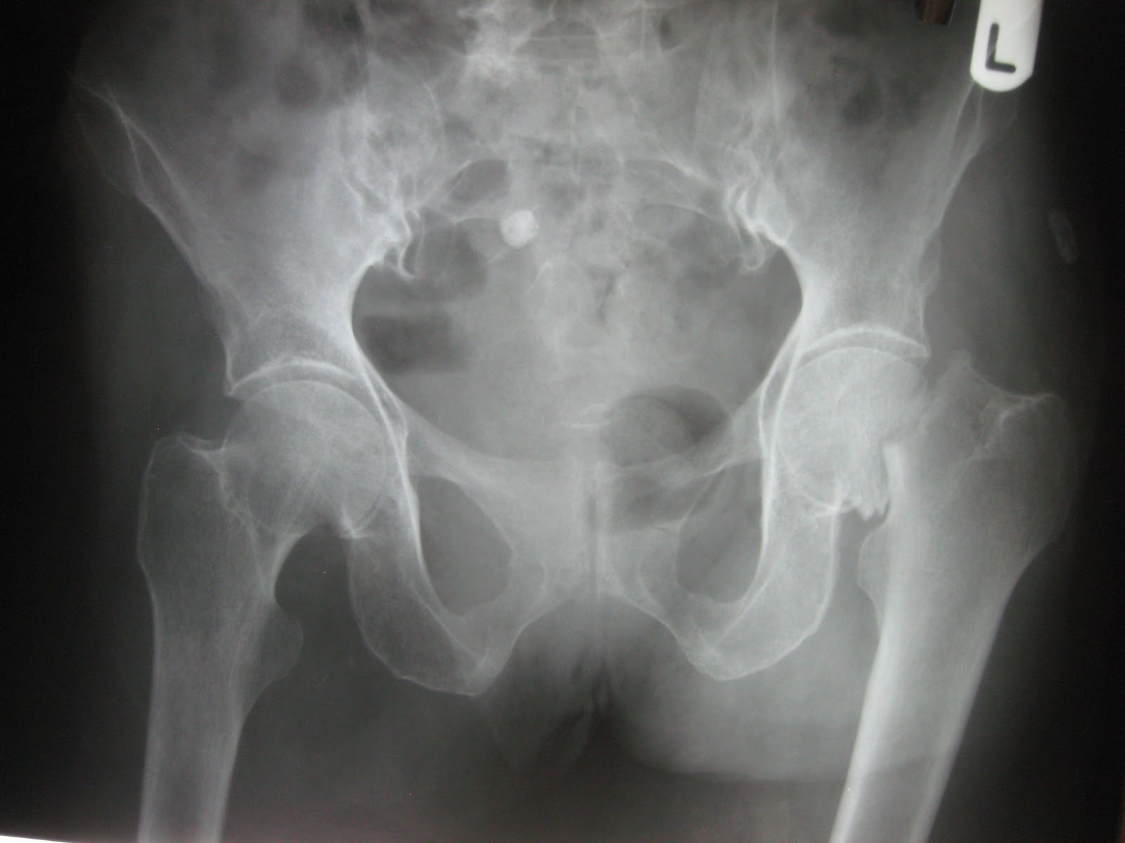 Fracture Hip Posted by Trent Wilson at 1:35 AM-4.bp.blogspot.com