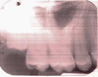 X-ray of Mushy's #2 molar X-ray of Mushy's #2 molar
