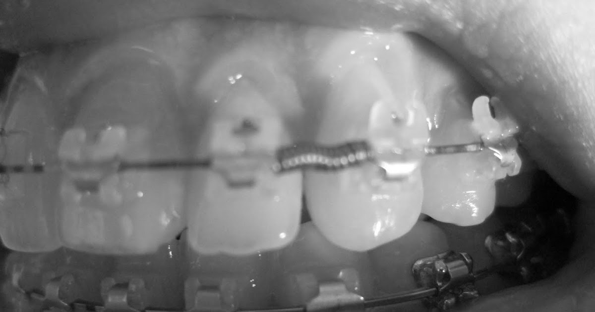 Springs 'n' Things emBRACING it a braces and jaw surgery diary