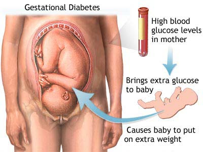 gestational diabetes