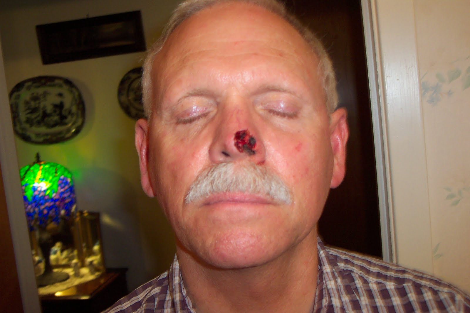 Nose Flap