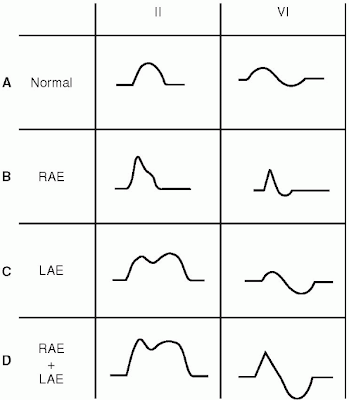 Cardiology Database: Back to basics: ECG criteria of atrial enlargement