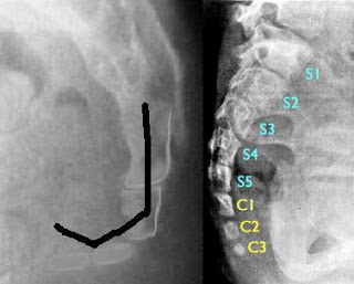 dislocated tailbone dislocated tailbone