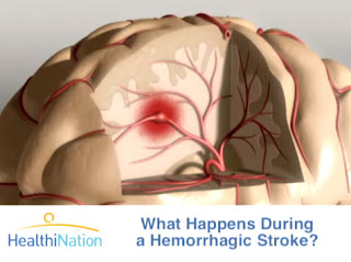 http://4.bp.blogspot.com/_c_uEfdPN9EI/TBitGgKTazI/AAAAAAAAAJA/n5FnnzbpxnU/s1600/Stroke.3DAnimation.brain.so.jpg