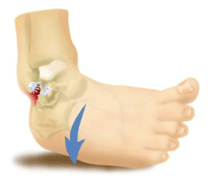 [AnkleSprain.gif]