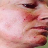 rosacea swelling