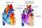 Hypoplastic Left Heart Syndrome