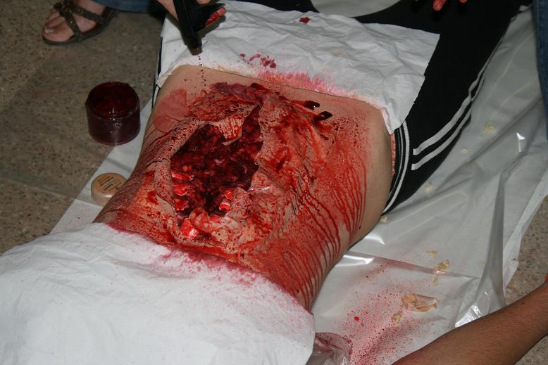 HEMORRAGIA TRATAMIENTO hemorragia tratamiento: