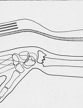 using a tuning fork for fractures using a tuning fork for fractures