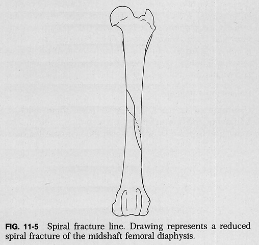 Tibia Bone Fracture Spiral Fracture-4.bp.blogspot.com